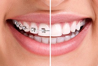Smile half with braces and half with clear aligners