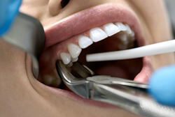 a woman receiving a tooth extraction
