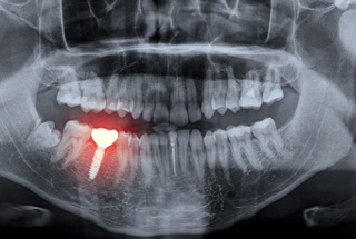 X ray of failed dental implant in McKinney