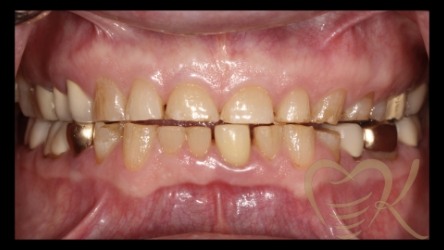 Close up of smile before full mouth reconstruction