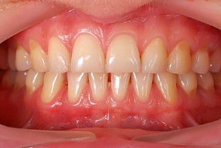 Close up of mouth with mild gum disease