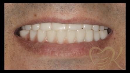 Close up of smile before hybrid denture