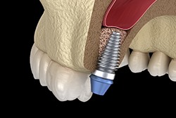 Digital illustration of a sinus lift in McKinney for dental implants
