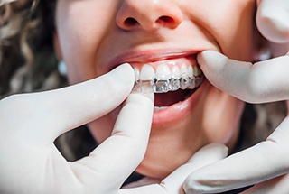 Dentist placing Invisalign aligner on patient