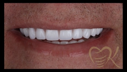 Close up of smile after getting overdenture