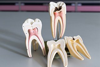 Models of teeth with inside of tooth visible