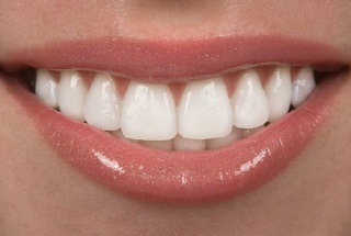 Close up of a beautiful white smile with dental veneers in McKinney